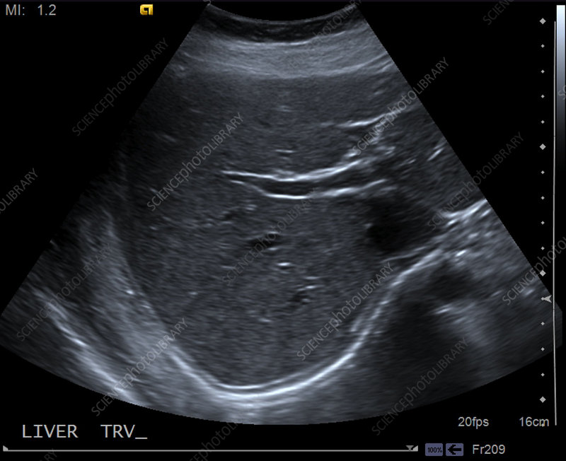 Ultrasound showing a normal liver